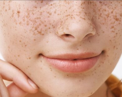 Điều trị tàn nhang: Chọn laser hay peel da?