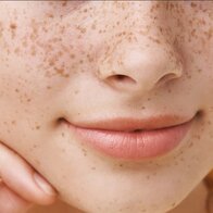 Điều trị tàn nhang: Chọn laser hay peel da?